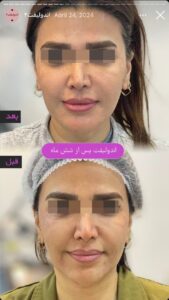 نمونه کار اندولیفت کلینیک آرارز در مشهد