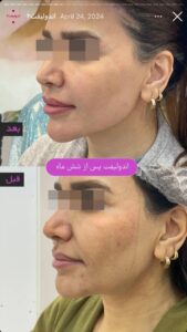 نمونه کار اندولیفت کلینیک آرارز در مشهد