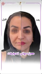نمونه کار اندولیفت کلینیک آرارز در مشهد