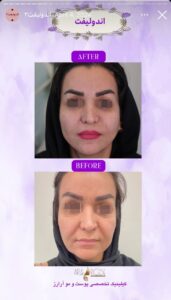 نمونه کار اندولیفت کلینیک آرارز در مشهد