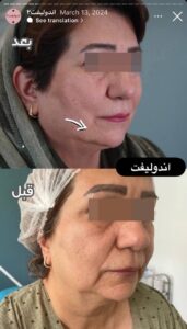 نمونه کار اندولیفت کلینیک آرارز در مشهد
