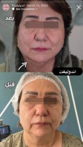 نمونه کار اندولیفت کلینیک آرارز در مشهد