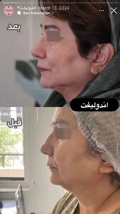 نمونه کار اندولیفت کلینیک آرارز در مشهد