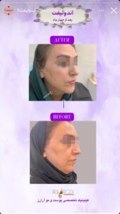 نمونه کار اندولیفت کلینیک آرارز در مشهد