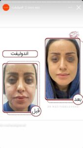 نمونه کار اندولیفت دکتر رزیتا دلقندی در مشهد