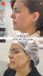 نمونه کار اندولیفت دکتر رزیتا دلقندی در مشهد