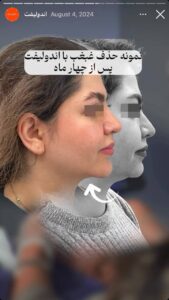 نمونه کار اندولیفت دکتر رزیتا دلقندی در مشهد