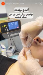 نمونه کار اندولیفت دکتر رزیتا دلقندی در مشهد