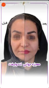 نمونه کار اندولیفت دکتر رزیتا دلقندی در مشهد