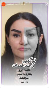 نمونه کار اندولیفت دکتر رزیتا دلقندی در مشهد