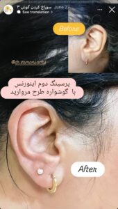 نمونه کار پیرسینگ گوش دکتر فرزانه زمانی در مشهد