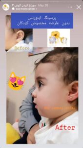 نمونه کار پیرسینگ گوش دکتر فرزانه زمانی در مشهد