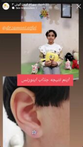 نمونه کار پیرسینگ گوش دکتر فرزانه زمانی در مشهد