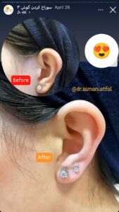 نمونه کار پیرسینگ گوش دکتر فرزانه زمانی در مشهد