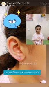 نمونه کار پیرسینگ گوش دکتر فرزانه زمانی در مشهد