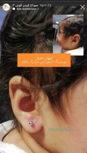 نمونه کار پیرسینگ گوش دکتر فرزانه زمانی در مشهد