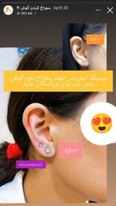 نمونه کار پیرسینگ گوش دکتر فرزانه زمانی در مشهد