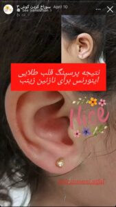 نمونه کار پیرسینگ گوش دکتر فرزانه زمانی در مشهد