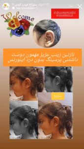 نمونه کار پیرسینگ گوش دکتر فرزانه زمانی در مشهد