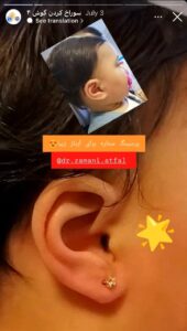 نمونه کار پیرسینگ گوش دکتر فرزانه زمانی در مشهد