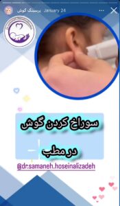 نمونه کار پیرسینگ گوش دکتر ثمانه حسینعلی زاده در مشهد