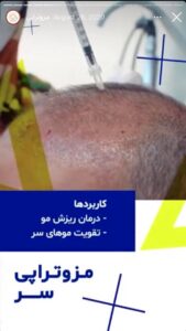 نمونه کار مزوتراپی کلینیک گهربد در مشهد