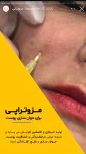 نمونه کار مزوتراپی کلینیک گهربد در مشهد