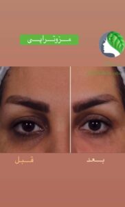 نمونه کار مزوتراپی کلینیک سی گل در مشهد