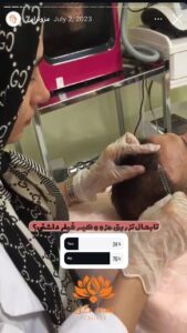 نمونه کار مزوتراپی کلینیک سی گل در مشهد