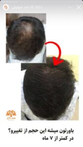 نمونه کار مزوتراپی کلینیک سی گل در مشهد