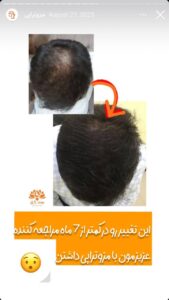 نمونه کار مزوتراپی کلینیک سی گل در مشهد