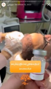 نمونه کار مزوتراپی کلینیک سی گل در مشهد