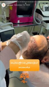 نمونه کار مزوتراپی کلینیک سی گل در مشهد