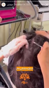 نمونه کار مزوتراپی کلینیک سی گل در مشهد