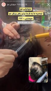 نمونه کار مزوتراپی دکتر مژگان کلالی در مشهد