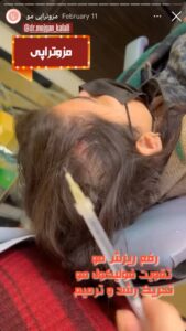 نمونه کار مزوتراپی دکتر مژگان کلالی در مشهد
