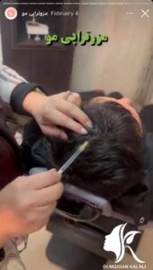 نمونه کار مزوتراپی دکتر مژگان کلالی در مشهد