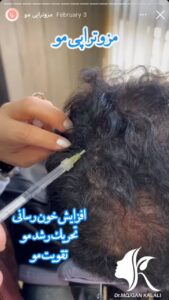 نمونه کار مزوتراپی دکتر مژگان کلالی در مشهد