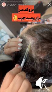 نمونه کار مزوتراپی دکتر مژگان کلالی در مشهد