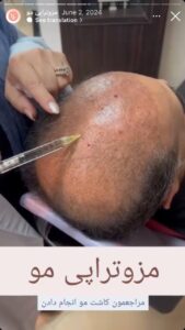 نمونه کار مزوتراپی دکتر مژگان کلالی در مشهد
