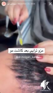 نمونه کار مزوتراپی دکتر مژگان کلالی در مشهد
