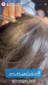 نمونه کار مزوتراپی دکتر مژگان کلالی در مشهد