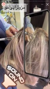 نمونه کار مزوتراپی دکتر مژگان کلالی در مشهد