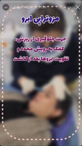نمونه کار مزوتراپی دکتر الهه اندخشیده در مشهد