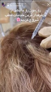 نمونه کار مزوتراپی دکتر فرشته طاهر در مشهد