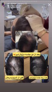 نمونه کار مزوتراپی دکتر فرشته طاهر در مشهد