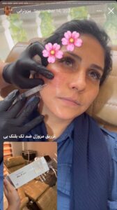 نمونه کار مزوتراپی دکتر فرشته طاهر در مشهد