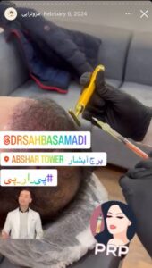 نمونه کار مزوتراپی دکتر صهبا صمدی در مشهد
