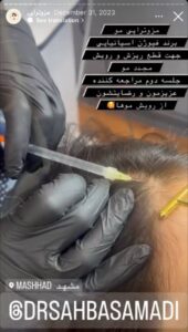 نمونه کار مزوتراپی دکتر صهبا صمدی در مشهد