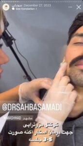 نمونه کار مزوتراپی دکتر صهبا صمدی در مشهد